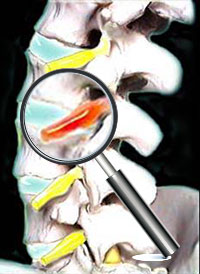 サブラクセーションとは